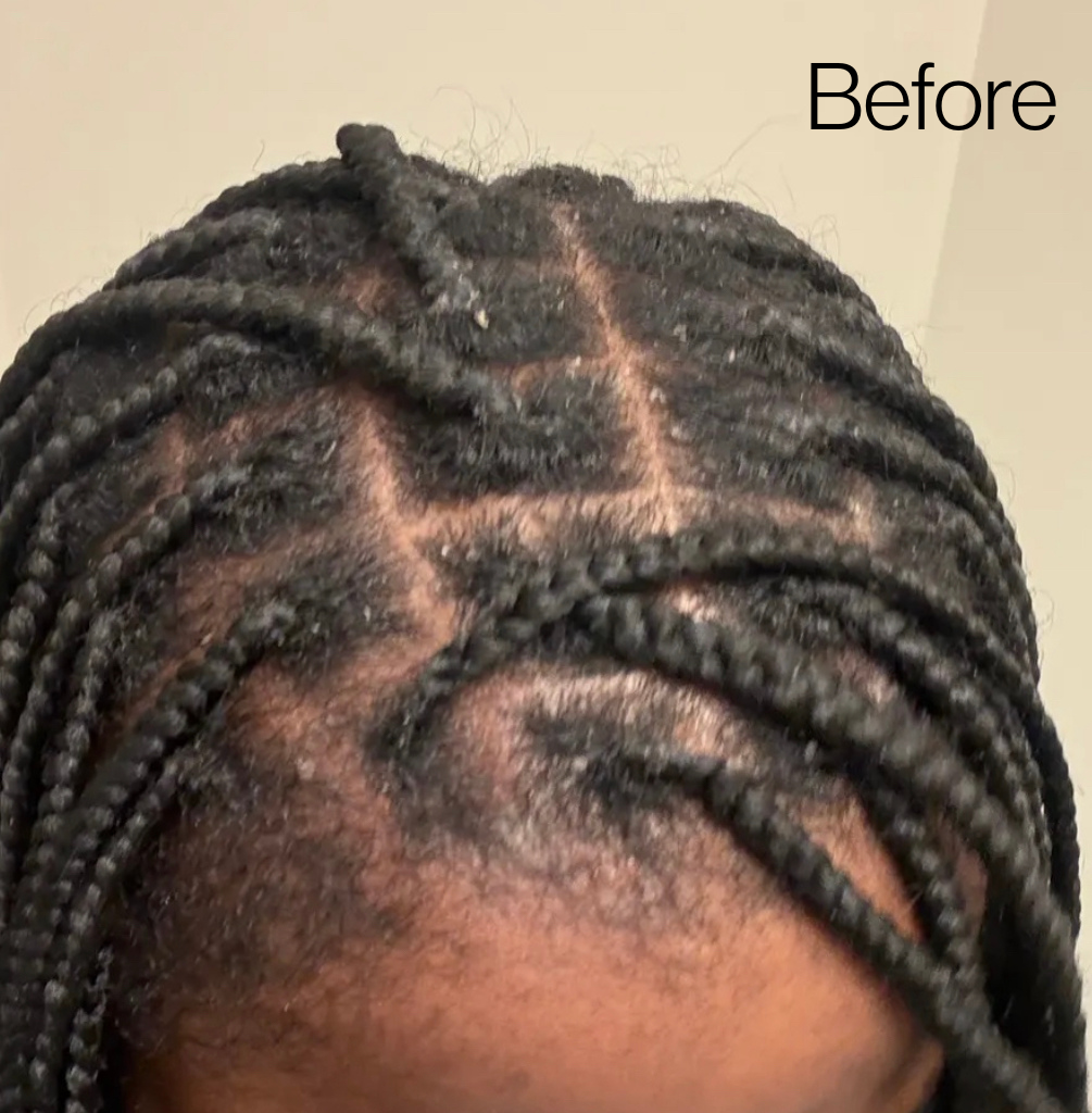 Unflake Wand™ | Scalp Exfoliant for Flakes & Buildup Between Wash Days