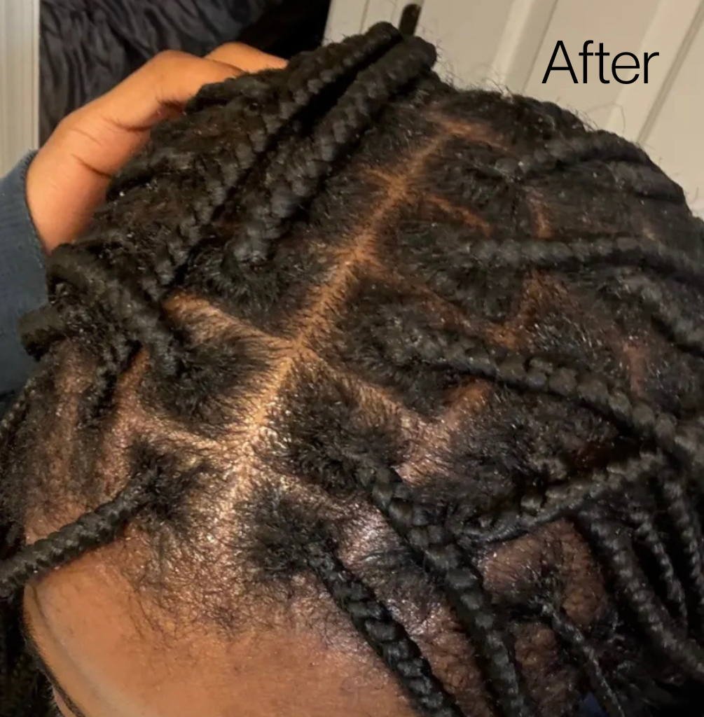 Unflake Wand™ | Scalp Exfoliant for Flakes & Buildup Between Wash Days